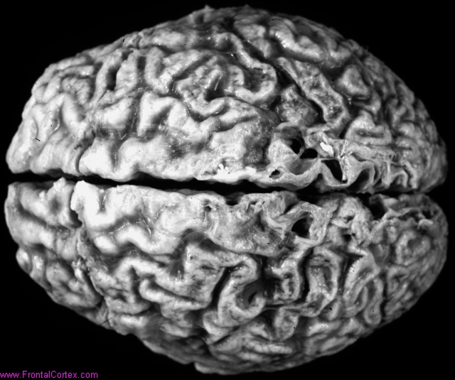 Alzheimer's disease, dorsal surface of brain