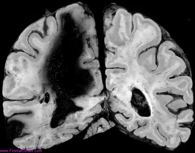 Lobar hemorrhages secondary to a