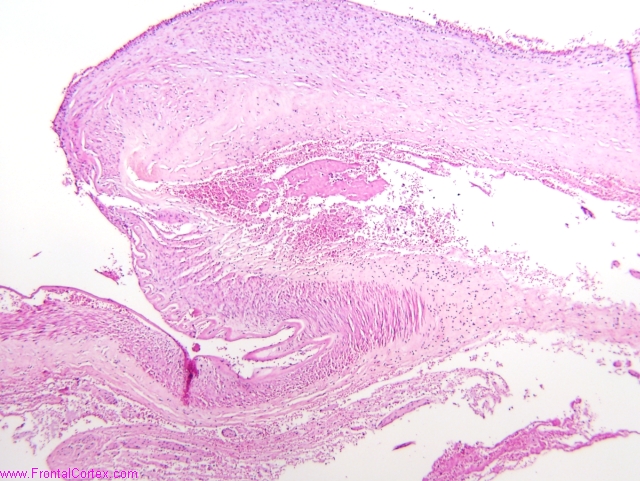 Transition from arterial wall to