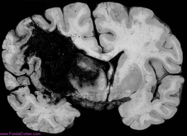 Hypertensive putaminal hemorrhag