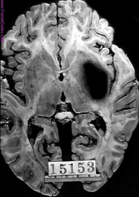 Contained hypertensive putaminal