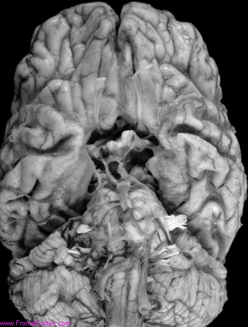 Alzheimer's disease, ventral surface of brain