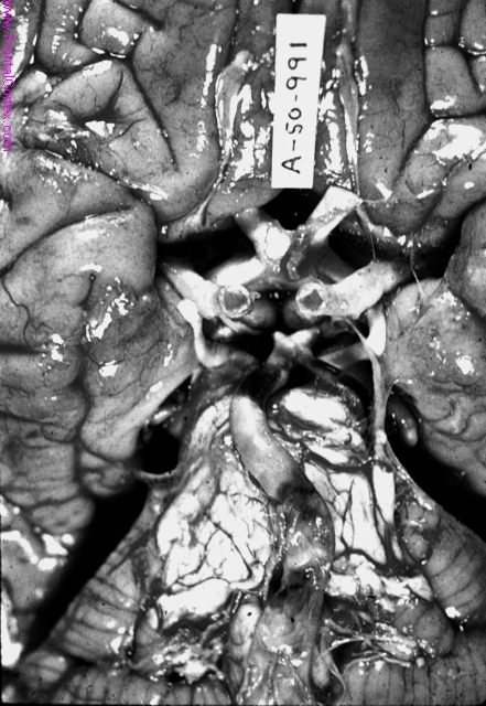 Basilar artery thrombosis