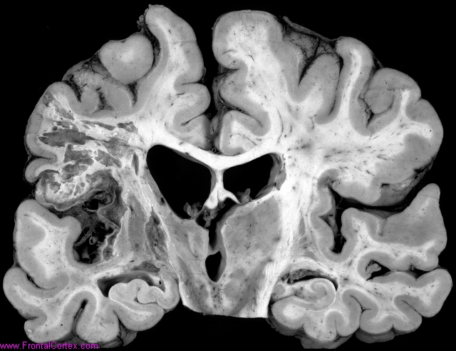 Cavitating infarcts within middl