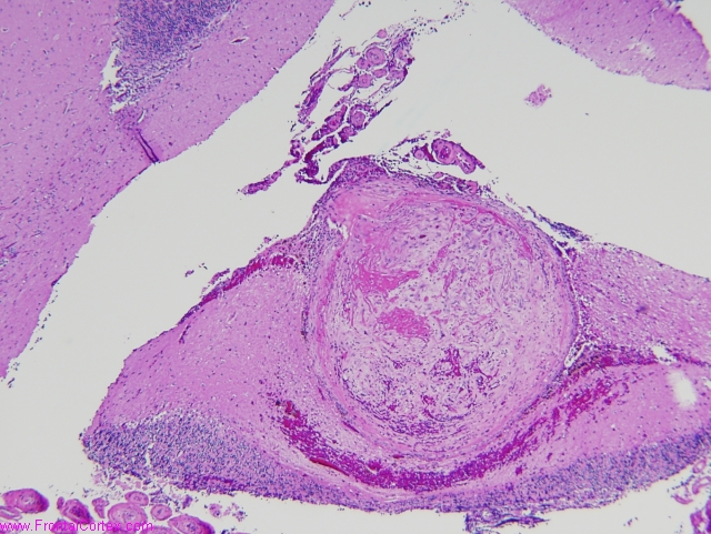 Thromboembolic occlusion, cerebe