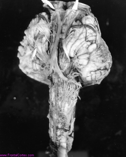 ChiariVentral001