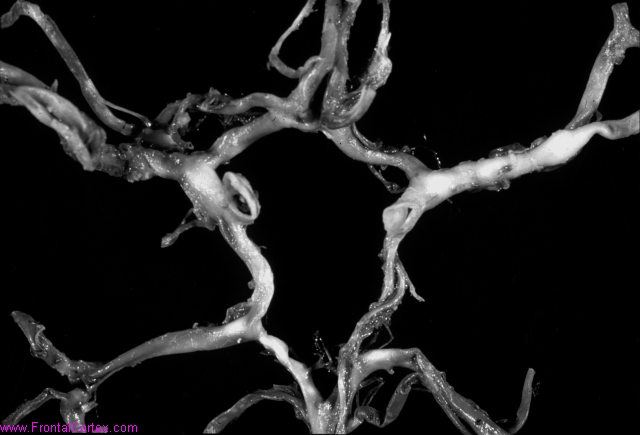 Circle of Willis