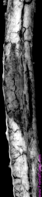 Intramedullary hemorrhage in a p