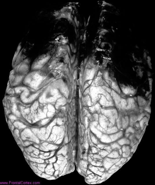 Venous infarcts, frontal lobes b