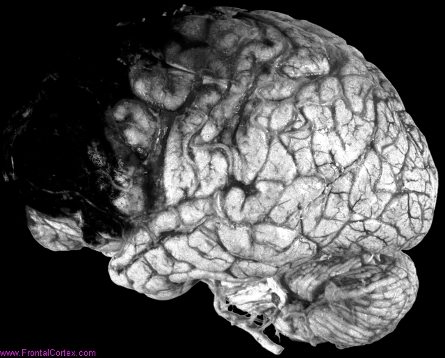 Venous infarcts, frontal lobes b