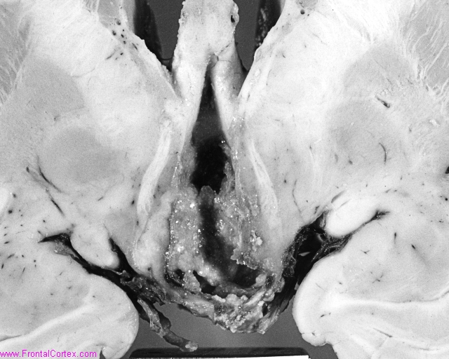 Craniopharyngioma001