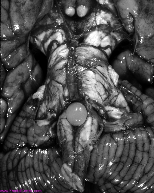 Ecchordosis1