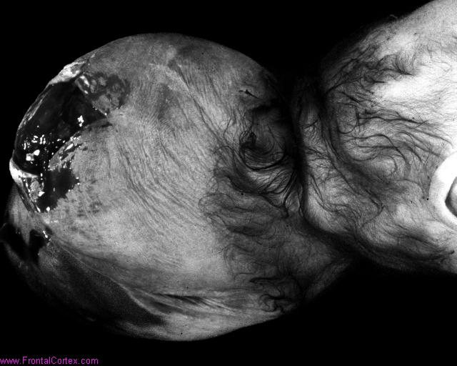 Encephalocele1