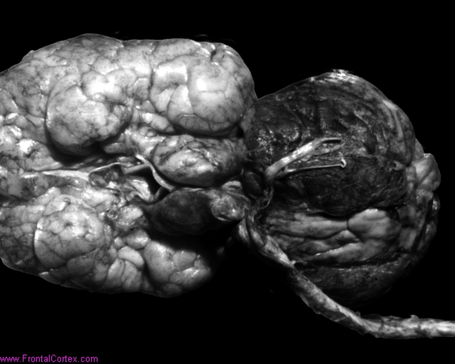 Encephalocele2