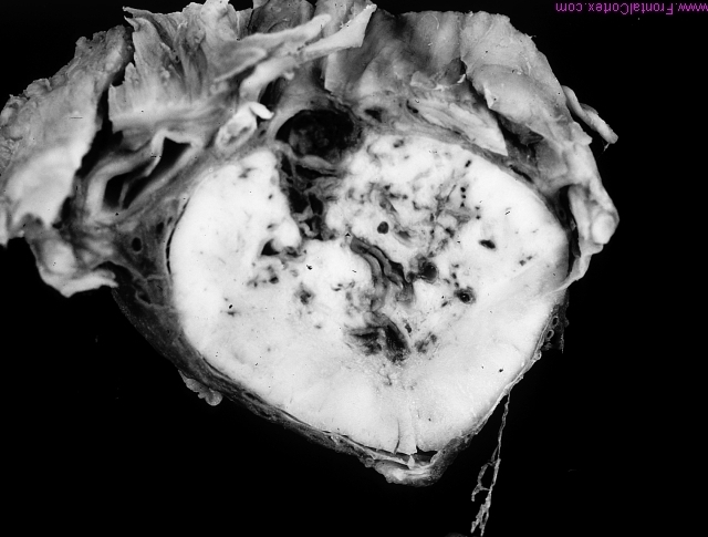 Foix-alajounine syndrome, spinal