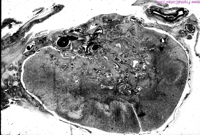 Foix-alajounine syndrome, spinal