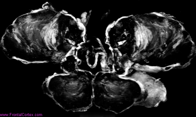 Giant saccular aneurysm, thrombo