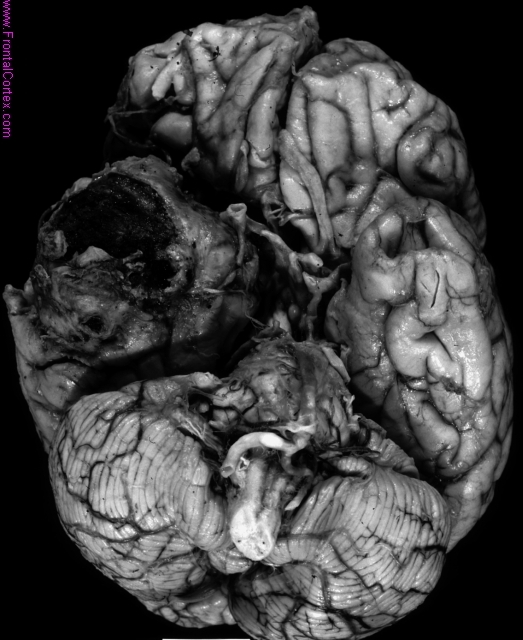 Giant middle cerebral artery ane