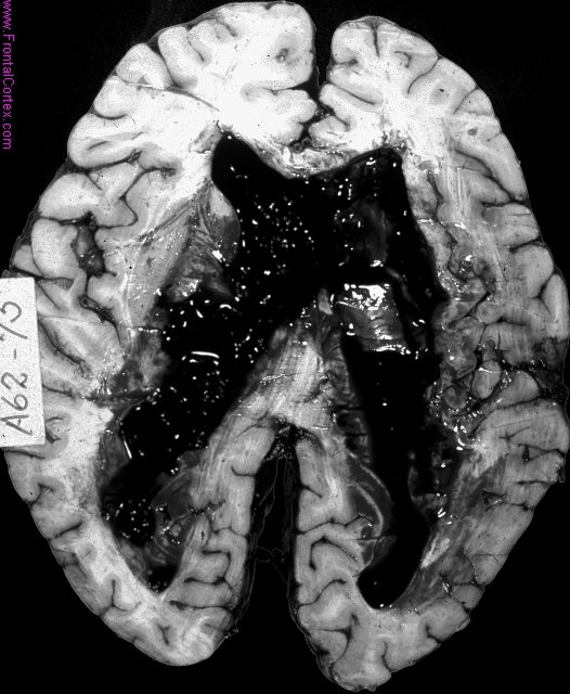 Hypertensive hemorrhage with rup