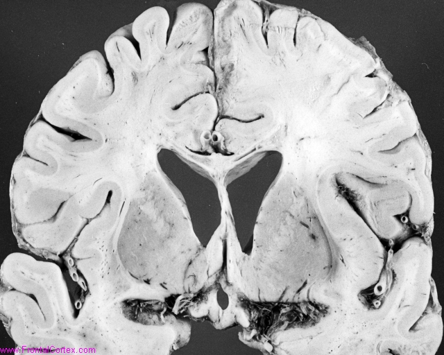 Coronal section