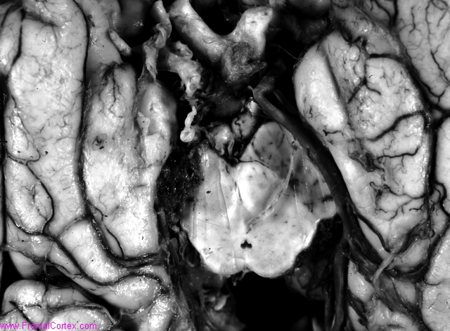 Arteriovenous malformation, midb