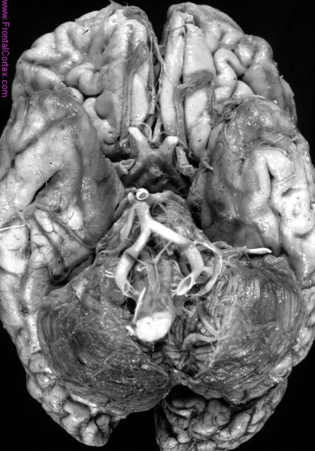 Multiple cavernous malformations