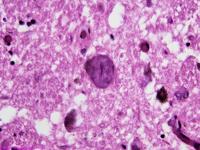 Alzheimer's disease, globose neurofibrillary tangle within the locus ceruleus