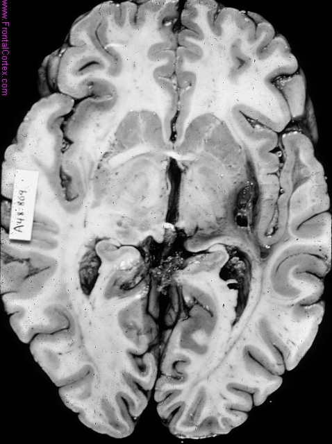 Organized putaminal hemorrhage