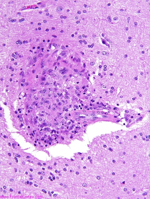 Granulomatous angiitis of the ce