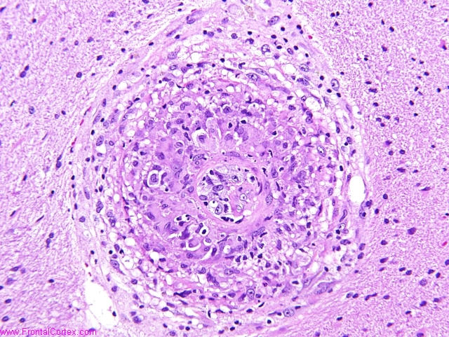 Granulomatous angiitis of the ce