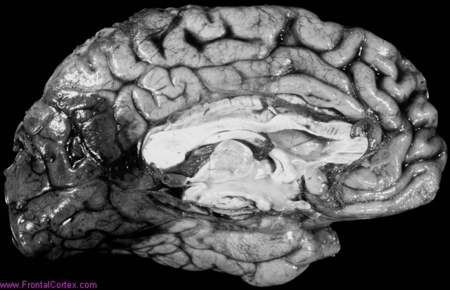 Posterior cerebral artery distri