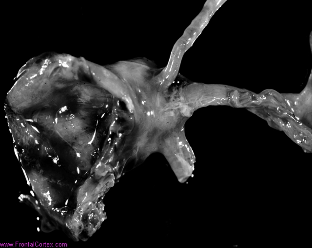 Ruptured middle cerebral artery