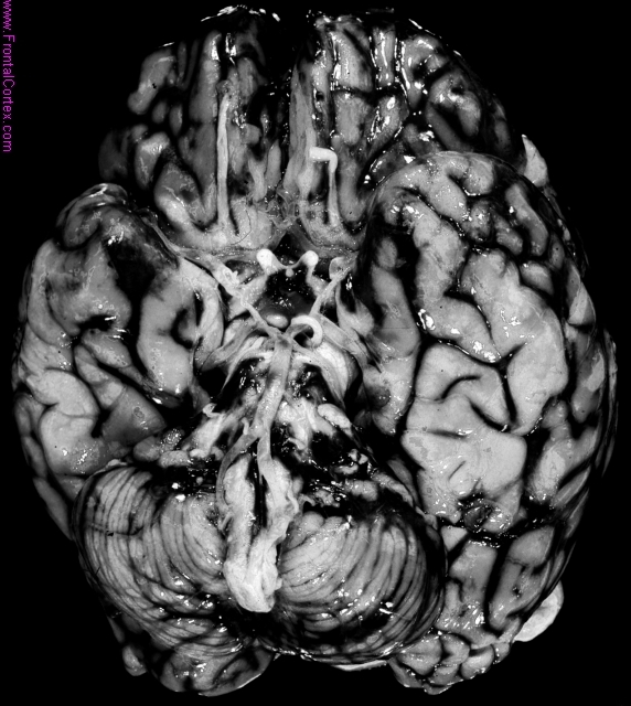 Subarachnoid hemorrhage, base of