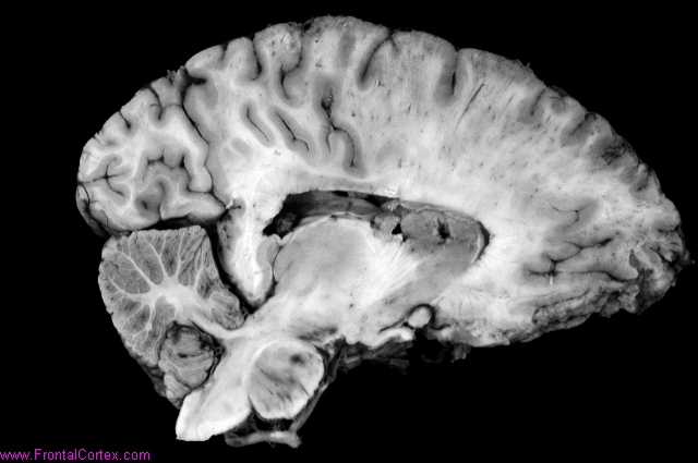 Middle cerebral artery distribut