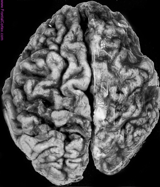 Sneddon syndrome