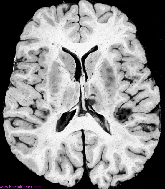 Multiple intraparenchymal hemorr