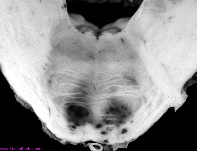 Pontine hemorrhages in a patient