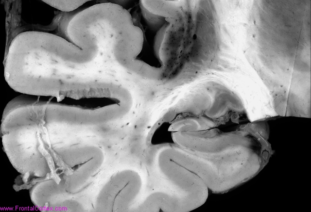 Capillary telangiectasis, insula