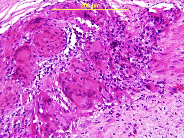 Giant cell arteritis, temporal a