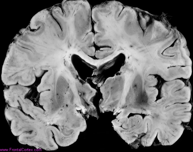 Thalamotomy1976