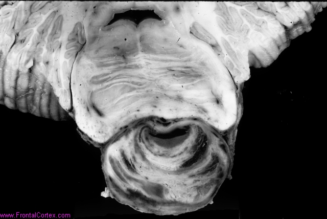 Basilar artery aneurysm, thrombo