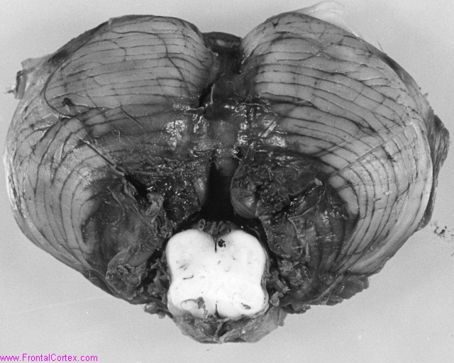 Acute bilateral tonsillar hernia