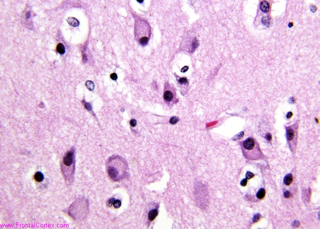 VWMDchromatolysis