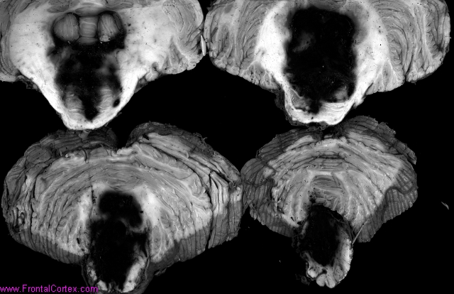 Hypertensive pontine hemorrhage