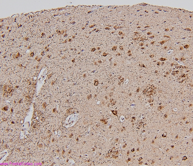 Alzheimer's disease, cerebral cortex, ubiquitin immunostaining