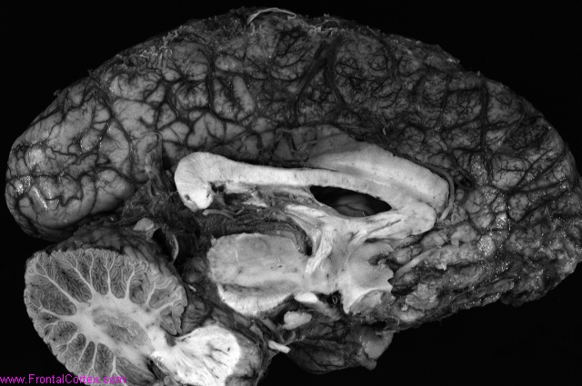 Organizing MCA infarct, sagittal