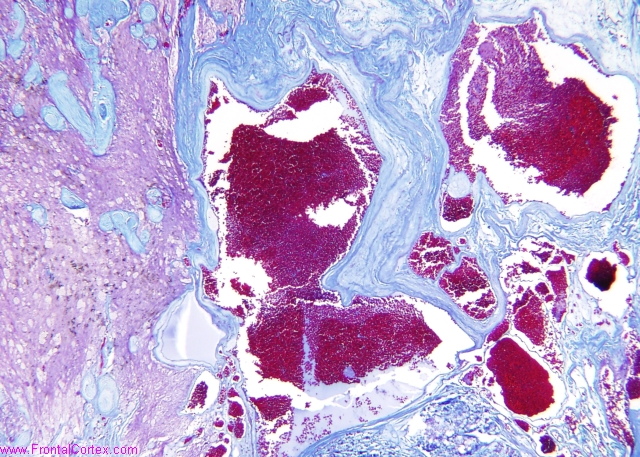 Cavernous malformation, trichrom