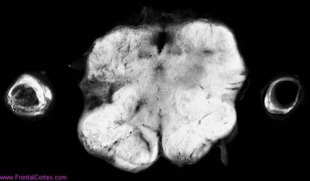 Dorsolateral medullary infarct,