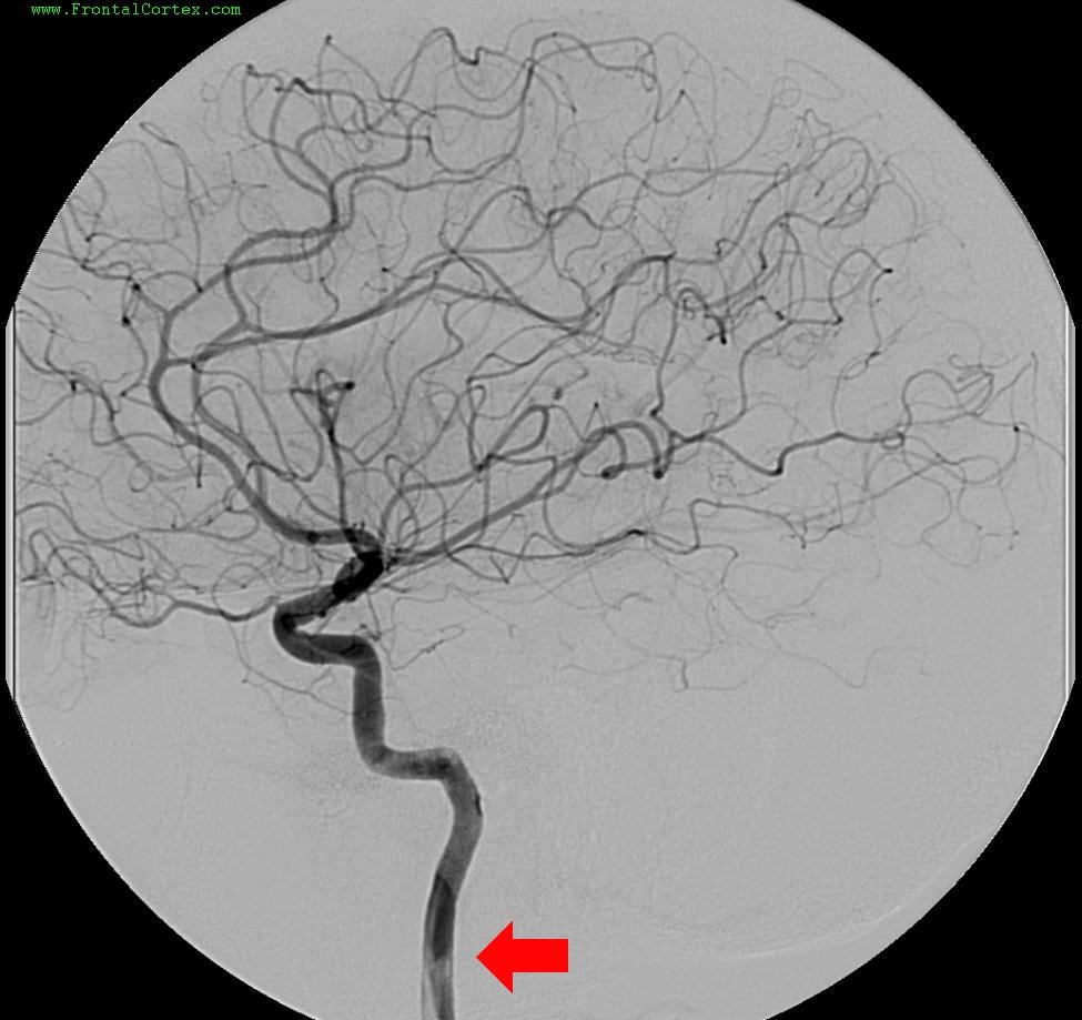 Angiogram ICA Cervical