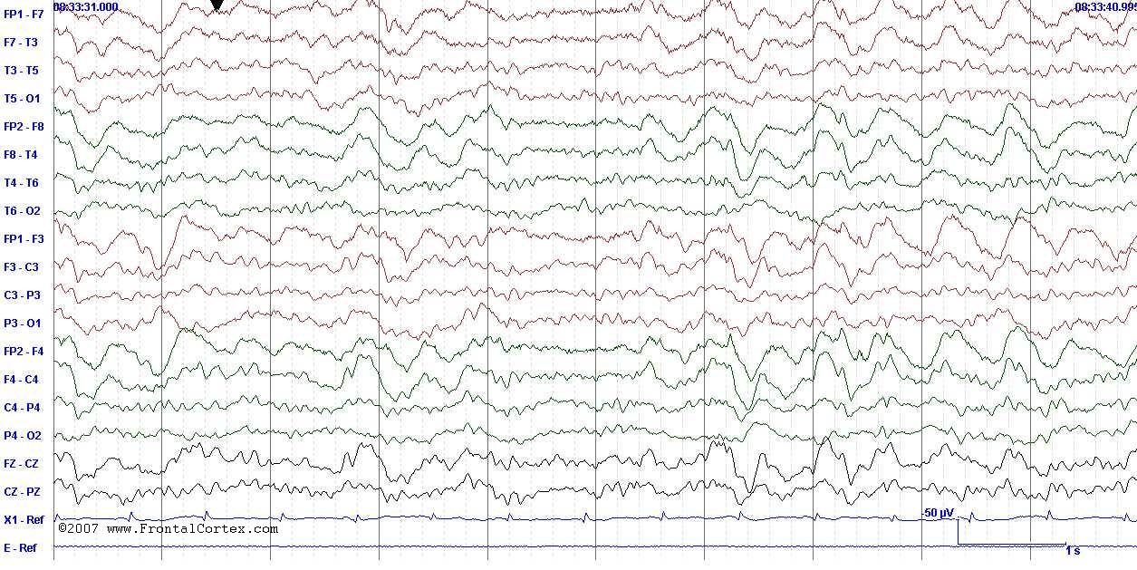 EEG FIRDA